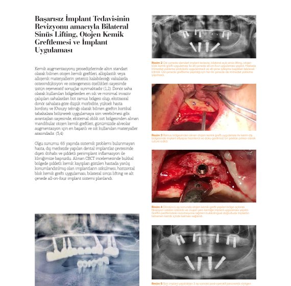 Bilateral Sinus Lifting, Autogenous Bone Grafting and Implant Placement for Revision of Failed Implant Treatment