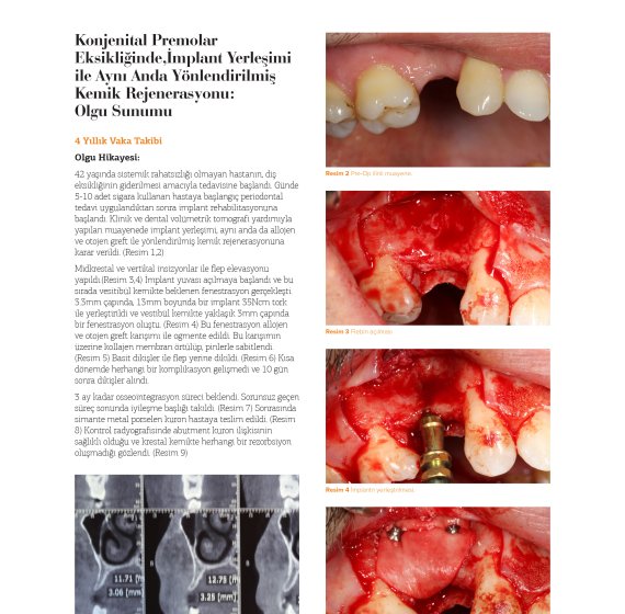 Bone Regeneration Directed Simultaneously with Implant Placement in Congenital Premolar Deficiency: Case Report