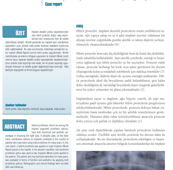 The effect of prosthetic options on clinical success of implant supported prosthesis – Case report