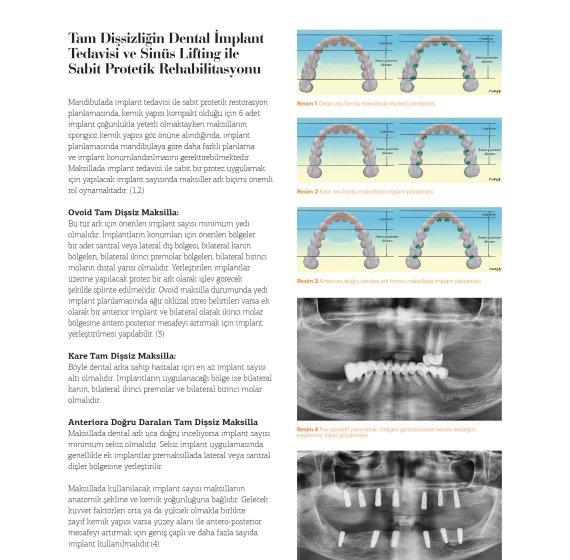 Fixed Prosthetic Rehabilitation of Complete Edentulism with Dental Implant Treatment and Sinus Lifting
