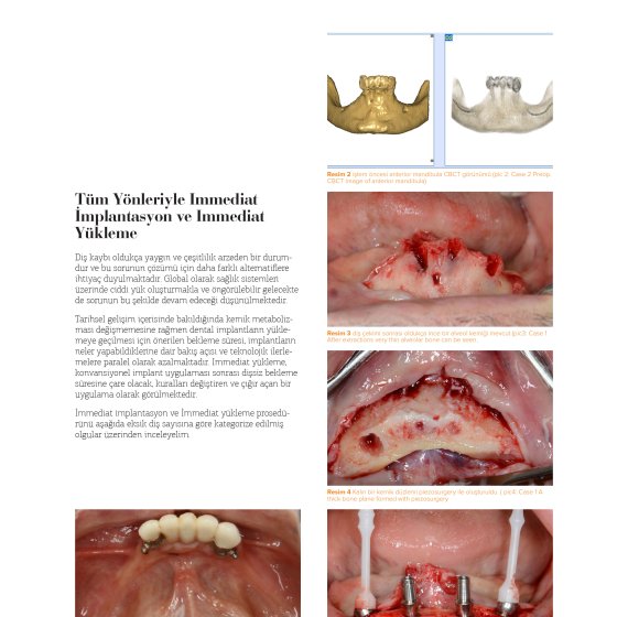 Immediate Implantation and Immediate Loading in All Aspects