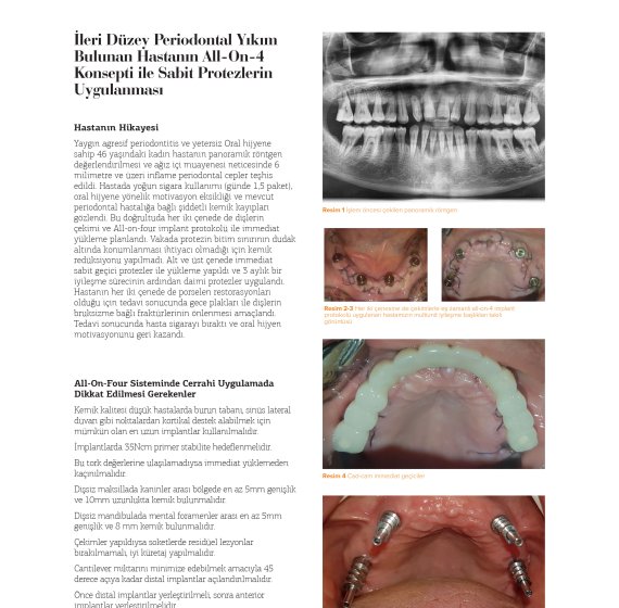 Application of Fixed Prostheses with All-On-4 Concept in a Patient with Advanced Periodontal Destruction