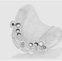Three Dimensional Implant Planning and Application with Surgical Guide