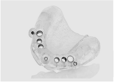 Three Dimensional Implant Planning and Application with Surgical Guide 