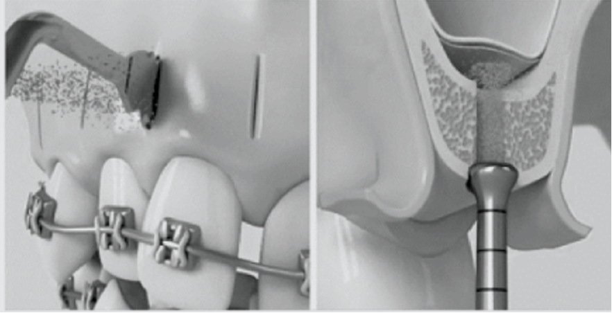 Sinus Lift Bone Applications and Piezo Surgery 